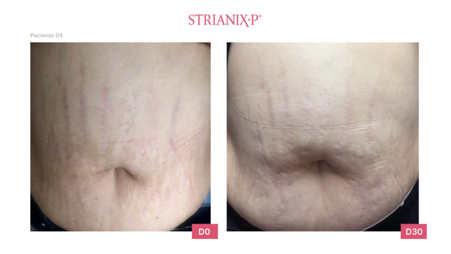 Crème Prévention Vergetures Strianix P Pink, 100g - Marque LSI - Neuf